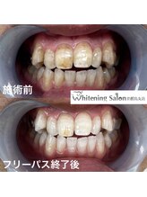 ホワイトニングサロン 京都烏丸店/ホワイトニング施術例