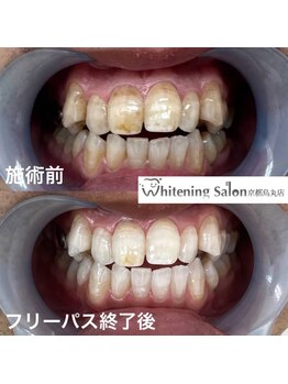 ホワイトニングサロン 京都烏丸店/ホワイトニング施術例