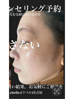 リベル 名古屋(Lebelle:)/ハーブピーリング専門名古屋