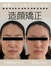 <歪み解消＞小顔・造顔矯正￥14,000→￥7,000