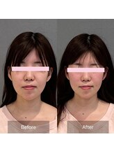 プライミー(PRIMY)/正面から見たビフォーアフター