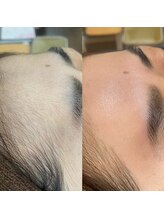 ナチュウル(Natulu)/シルク糸脱毛