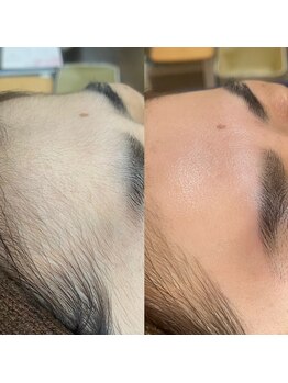 ナチュウル(Natulu)/シルク糸脱毛