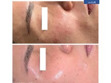 コリオ(KoRiO)/ピーリング［狭山ヶ丘］