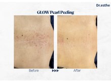 オーシャンブルー 福岡店(OCEAN BLUE フェイシャル&ボディ)/【韓国】グロウパールピーリング