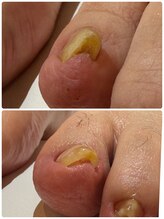 緒々 ワンプラス(one+)/【巻き爪ケア】施術前→2回目