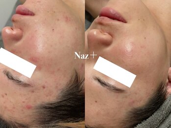 リベルテ(Liberte)/セレクトニキビケア管理