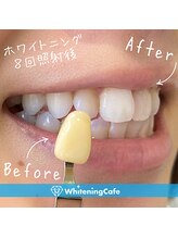 ホワイトニングカフェ 池袋東口店/ホワイトニングビフォーアフター