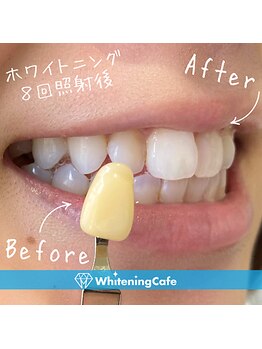ホワイトニングカフェ 池袋東口店/ホワイトニングビフォーアフター