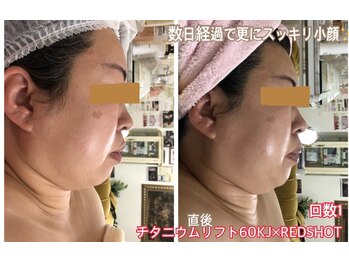 アルページュ(Arpege)/チタニウム×REDshot