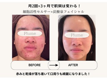 プルーム(Plume)/3ヶ月の肌育成結果(毛穴ケア)