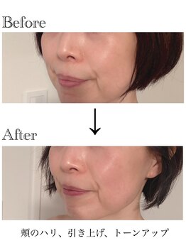 サブリエ(Sablier)/50代 施術7回目