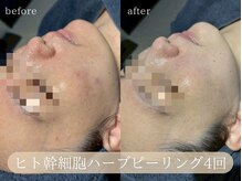 ハジュ(HAJU.)/ハーブピーリングでトーンアップ