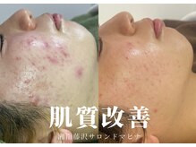 肌質改善専門【Salon da Mahina】毛穴ケア/ニキビケア/ハーブピーリング