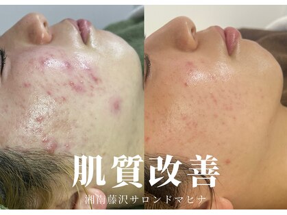 肌質改善専門【Salon da Mahina】毛穴ケア/ニキビケア/ハーブピーリングの写真