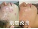 肌質改善専門【Salon da Mahina】毛穴ケア/ニキビケア/ハーブピーリングの写真