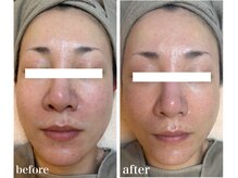 ミミーの雰囲気（頬の赤み+ニキビ・跡も目立ちにくくなりコンシーラー不要に）