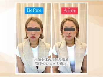 エモア メディカル整体院 恵比寿院(Emoa)/【20代女性】小顔矯正