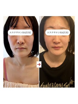 ハズキ(HAZUKI)/自慢のピン肌/たるみ改善/ハーブ