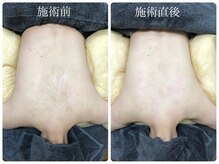 シェミー(CHEZ MEE)/1dayブライダルエステ（背中）