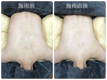 シェミー(CHEZ MEE)/1dayブライダルエステ（背中）