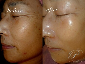 パールホワイトニング/ハーブピーリングでトラブル改善