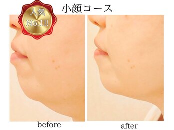 ブライトサロン(Bright Salon)/超スッキリ！小顔フェイシャル