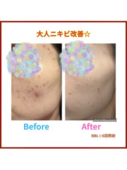 リゾートサロンドマーレ(Resort Salon de MARE)/BBL光6回照射でニキビ激減！！