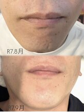 アトリエバンビ(atelier Bambi)/メンズ・ひげ脱毛＊