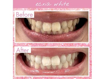 ルアナシンフォニア エクシア 東銀座店(Luana-Sinfonia)/ホワイトニングビフォーアフター