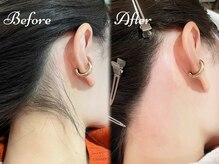 ピミル(PIMIL)/うなじ脱毛