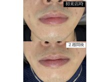 フラット(FLAT)/メンズ脱毛