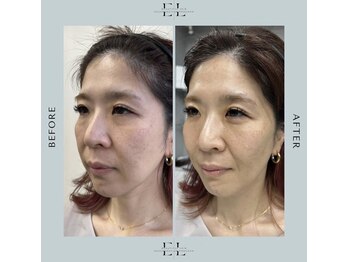 スプレール 水戸店/ExoLif(エクソリフト)