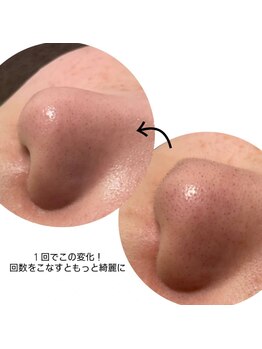 ウィズティ(with.T)/毛穴集中コース