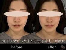 チョコバリ 新宿店(chocobari)/小顔×リフトアップ(美容鍼)20代