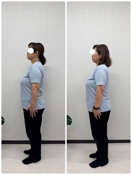 ラフテル鍼灸整骨院/反り腰での腰痛にピラティス！