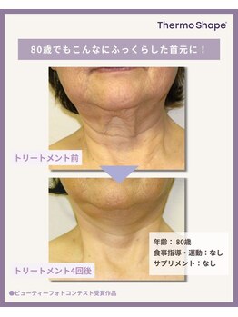 ピカイチ 上通店(pikAicHi)/サーモシェイプフェイス