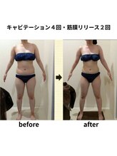 クリア(Clear)/キャビテーション・筋膜リリース