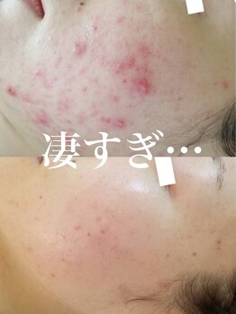 ピウ(piu)/【肌質改善】ハーバルピーリング