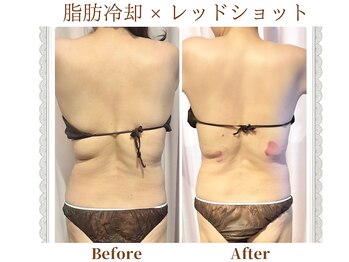 モテスリム/脂肪冷却×レッドショット