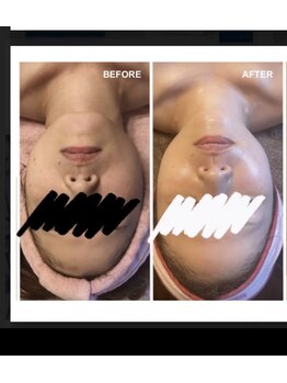 クラウン 心斎橋店(CROWN)/カーボキシー炭酸パック