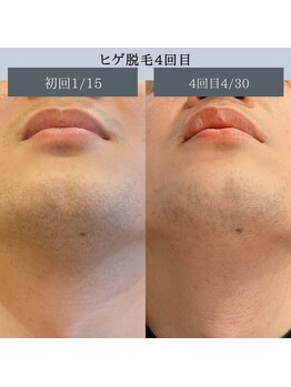 エピ リブレ(8epi.Libre)/ヒゲ脱毛♪圧倒的抜け感を約束