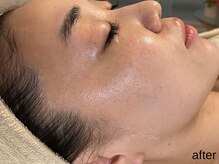 サロン ド エメ(salon de aimer)/【After】頬輪郭スッキリと♪