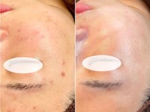 ラエッセ 恵比寿(LAESSE)の雰囲気（ニキビケア・予防で繰り返さない肌を目指す根本的なケア）