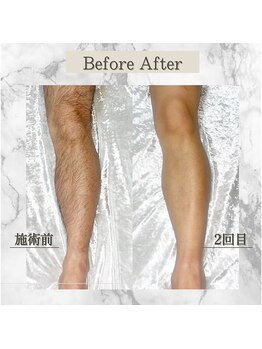 フォー(the 4)/before &nbsp;&nbsp;&nbsp;after