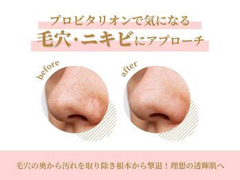 パーフェクトフェイスビューティー 三宮店(PERFECT FACE BEAUTY)/ハーブピーリングでアプローチ