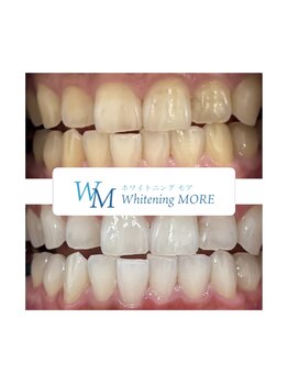 ホワイトニング モア(Whitening MORE)/ストレスフリー!