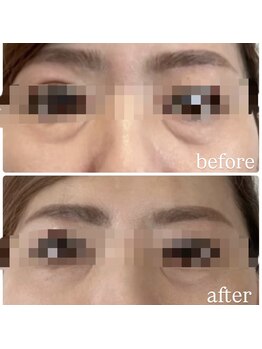 ラルミエール 緑店はなれ(la lumiere)/レモンボトル×コラーゲン糸