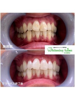 ホワイトニングサロン 名古屋駅店/【ホワイトニング施術例】