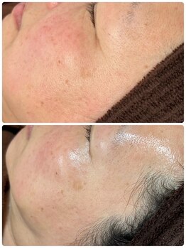 サロン ワン(salon one)/毛穴、くすみ、赤み、しみ、しわ